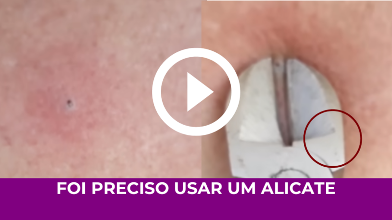 MAIOR CRAVO DO MUNDO foi preciso UM ALICATE PARA REMOVER